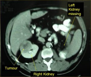 tests  kidney