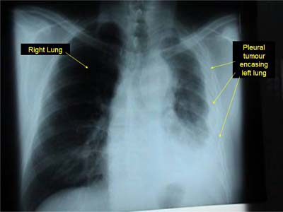 Mesothelioma causes.diagnosis treatment photos videos 120_150_Lung_Mesothelioma.jpg