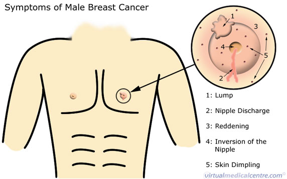breast cancer. Symptoms of Male Breast Cancer
