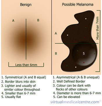 melanoma skin cancer. Examination of Skin Cancer