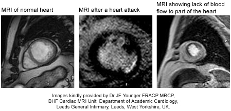 Cardiac MRI reveals energy drinks alter heart function