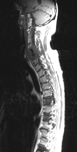 Lymphoma of the Spinal Cord