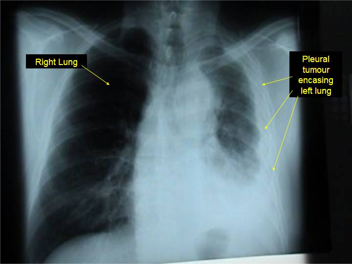 x rays of lung cancer. example of an x-ray