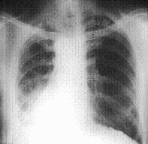 Asbestosis x-ray image. CT scan of the chest will demonstrate lung fibrosis.