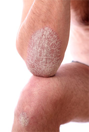 Psoriasis video picture